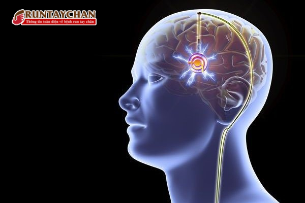  Điều trị hiệu quả Parkinson và run vô căn từ thiết bị cấy ghép kích thích não bộ